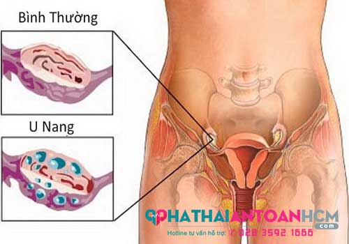 Dấu hiệu nhận biết u nang buồng trứng bên phải ở phụ nữ