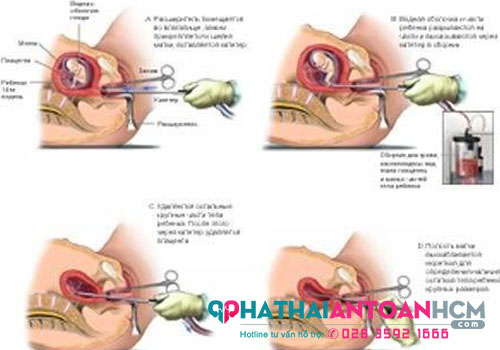 Địa chỉ phá thai ở quận 1