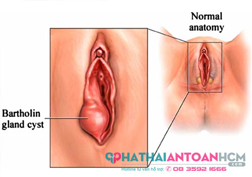 Hình ảnh viêm tuyến bartholin ở phụ nữ