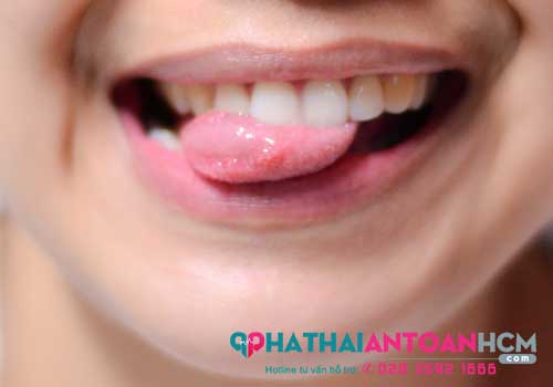 Mụn rộp sinh dục ở lưỡi: Nguyên nhân biểu hiện và cách chữa trị