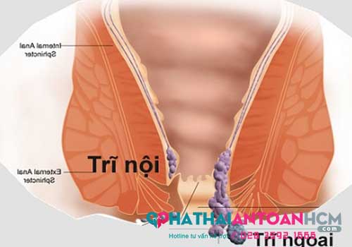 Trĩ nội và trĩ ngoại khác nhau như thế nào