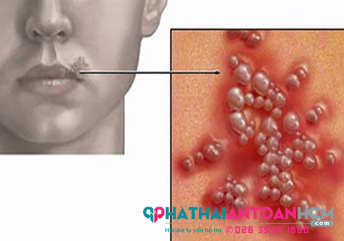Xét nghiệm mụn rộp sinh dục ở đâu chính xác?
