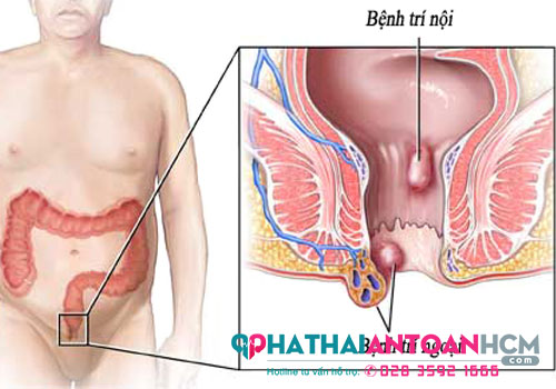 Cách điều trị trĩ ngoại độ 2 như thế nào