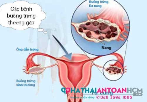 Khám phụ khoa có thể nhận biết sớm những bất thường ở buồng trứng