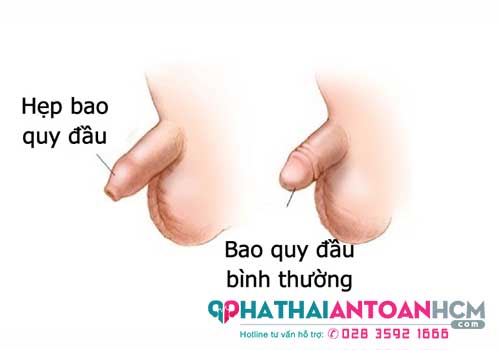 Khám chữa hẹp bao quy đầu ở đâu TPHCM