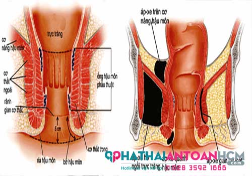 Nguyên nhân và cách điều trị áp xe hậu môn hiệu quả