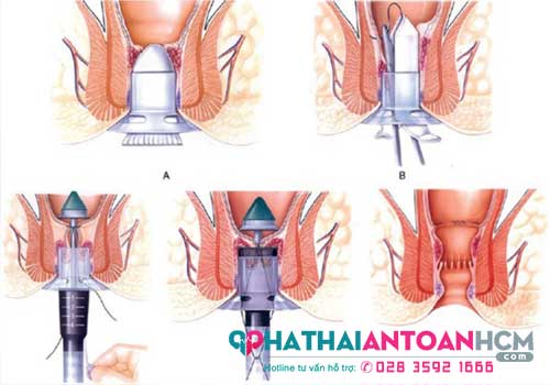 Trĩ ngoại tắc mạch là gì và cách điều trị như thế nào?